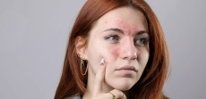 Rosacea Management Near Fairfax, VA: Treatments Explained